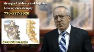 Spondylolisthesis  Back Injury Caused by Trauma from a Car Accident  Douglasville Accident Lawyer [upl. by Mossberg]