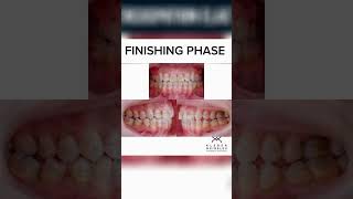 FINISHING PHASE  ORTHODONTIC TIPS Shorts [upl. by Spratt]