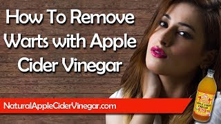 How to Naturally Remove Warts with Apple Cider Vinegar [upl. by Gael676]