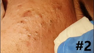 BIG BLACKHEADS EXTRACTIONS on Happy  2 [upl. by Nahgem]