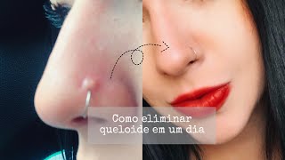 Como acabar com a queloide do piercing  Sharon Mel [upl. by Yelsek]