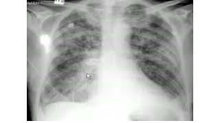 Pulmonary edema XRay review [upl. by Shugart]