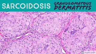 Sarcoidosis amp Granulomatous Dermatitis Pattern  Inflammatory Dermatopathology Basics [upl. by Nnayelsel]