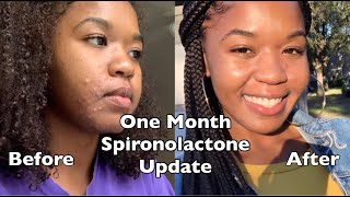 My Hormonal Acne Journey  Spironolactone 1 Month Update  Side Effects amp Routine [upl. by Ennovi]