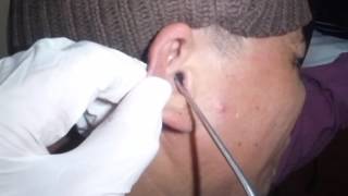 Earwax Removal and Suctioning of Ear Fungus Otomycosis [upl. by Alissa]