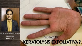 Keratolysis ExfoliativaRepeated peeling of skin from palm and sole Hath aur paw se Chamdi Nikalna [upl. by Ammej]