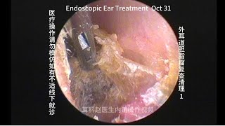 Re examination and cleaning of external auditory canal cholesteatoma 20241031 [upl. by Nylemaj936]