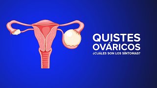 Quistes de Ovario ¿Cuáles son los síntomas [upl. by Claudie]