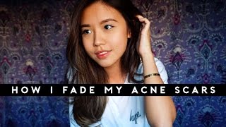 How To Fade Acne Scars  Banish Skincare Review [upl. by Sheline]