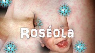 Virus Herpes Humano 6 Y 7Roseola [upl. by Narol]