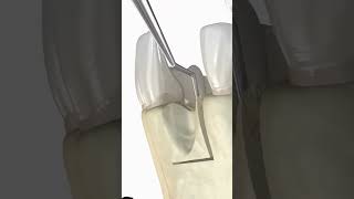 Dental Bone Graft 3D Animationshorts [upl. by Eachelle]