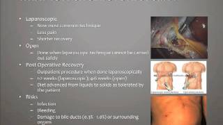 What is a Cholecystectomy [upl. by Cade]