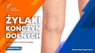 Żylaki kończyn dolnych  metody leczenia [upl. by Nilatak]