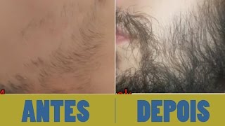 Antes e depois  minoxidil kirkland  barba  7 meses [upl. by Seyah762]