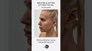 LIFTING Facial Before amp After 5 luni de la operație la Clinica Doctor Levy din București [upl. by Elahcar710]