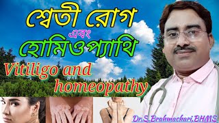 Vitiligo  vitiligo and homeopathy  vitiligo treatment  leucoderma in bengali language [upl. by La Verne]