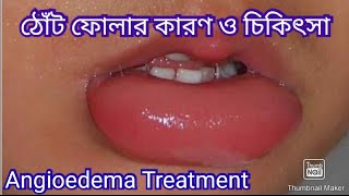 ঠোঁট ফোলার কারণ  ঠোঁট ফোলা কমানোর উপায়  Angioedema Treatment [upl. by Knowle]