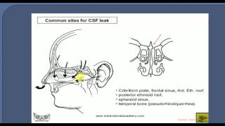 ENT LECTURES  CSF RHINORRHEA [upl. by Pillyhp516]