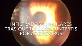 Infiltrados numulares tras queratoconjuntivitis por adenovirus [upl. by Attenad]