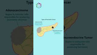 Types of Pancreatic Cancer Explained  Knowing the Different Forms  Dr Vivek Sukumar [upl. by Lutero]