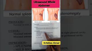 Ultrasound Whole Abdomen Cystitis doctor ultrasound mbbsdoctor bums doctorsdream [upl. by Camp]