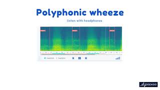 Lung sounds  polyphonic wheeze [upl. by Teferi]