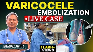 Live Case  Grade 3 Varicocele Embolization  NonSurgical Treatment of Varicocele  Dr Arun Gupta [upl. by Guildroy]