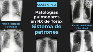 042  Tórax anormal Patrones radiológicos consolidación atelectasia bula cavitación etc [upl. by Aniteb628]