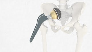 Implantation einer HüftgelenkEndoprothese Einsetzen eines künstlichen Hüftgelenks [upl. by Arayk]