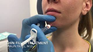 Chin augmentation with filler Restylane Lyft by Dr Shaun Patel [upl. by Chloras]