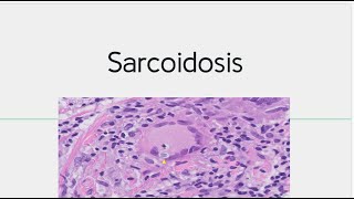 Sarcoidosis  Morphology Pathogenesis [upl. by Noirrad733]