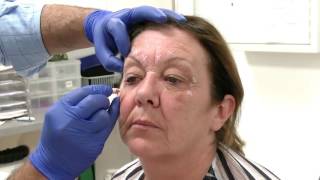 Injecting Botox into the Glabella region  Training Video For Medical Professionals Only [upl. by Stephania]