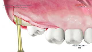 PIEZOSURGERY  Dr Fabrizio Fontanella  Upper tooth extraction [upl. by Kcirddet]