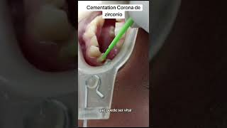 protocolo de cementación de una corona de zirconio [upl. by Aisylla]