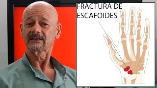 Fractura del hueso escafoides de la muñeca [upl. by Hak]