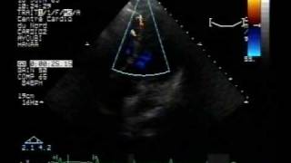 echocardiogram multiple apical ventricular septal defects 4chambers view [upl. by Eelitan]