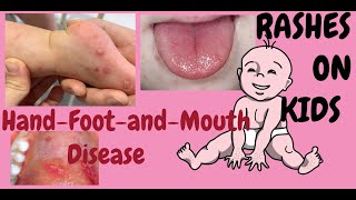 Hand foot and mouth disease Also known as HFMDDermatology lecture for MBBS [upl. by Quinton]