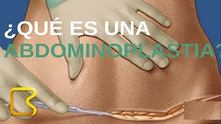 Recomendaciones postoperatorio de Abdominoplastia [upl. by Levison]