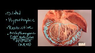 What is Cardiomyopathy [upl. by Doubler]