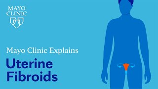 Mayo Clinic Explains Uterine Fibroids [upl. by Analise]