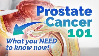 What You Need To Know About Prostate Cancer [upl. by Lleryt]