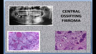 Central Ossifying Fibroma [upl. by Siaht]