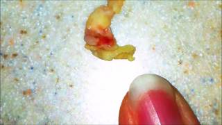 Worlds Largest Tonsil Stones  Cured [upl. by Sybley671]