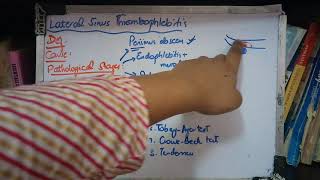 LATERAL SINUS THROMBOPHLEBITIS a complication of Suppurative otitis media part 1 [upl. by Harima]