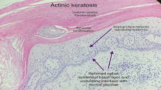 actinic keratosis [upl. by Callida]