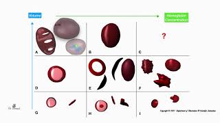 Anemia de células falciformes [upl. by Hughes690]