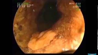 Advanced Endoscopic Imaging for Characterization of Heterotopic Gastric Mucosa in the Esophagus [upl. by Eemia]