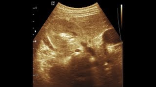 15 years Girl Increase Cortical Echogenicity Right Kidney [upl. by Dib]