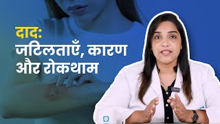 दाद जटिलताएँ कारण और रोकथाम [upl. by Gnas]