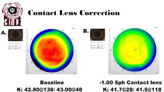 Anisometropia and Aniseikonia Treatment [upl. by Adnoval49]